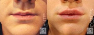 Aumento de labios
