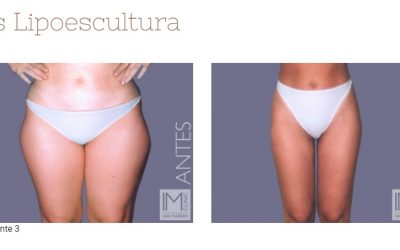 Todo lo que querías saber sobre la liposucción